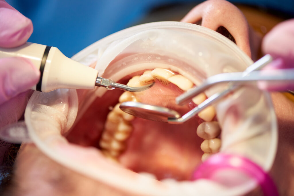 GBT (Guided Biofilm Therapy) – kompleksowa higienizacja jamy ustnej w gabinecie stomatologicznym