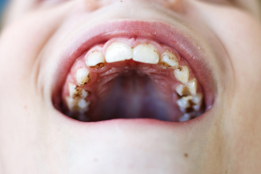 Próchnica u dzieci – laserowe leczenie zębów